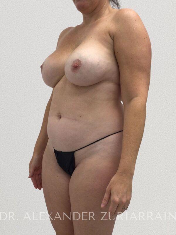 Lipo360 before & after photo