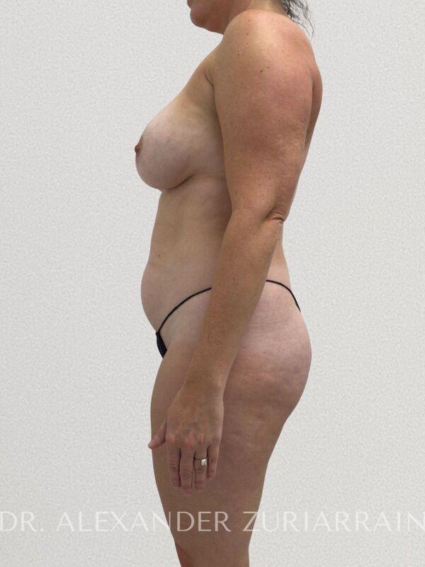 Lipo360 before & after photo