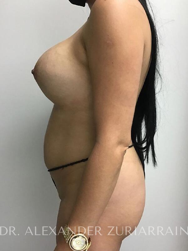 Liposuction before & after photo