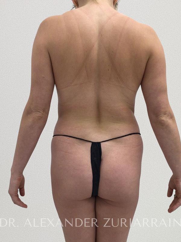 Liposuction before & after photo