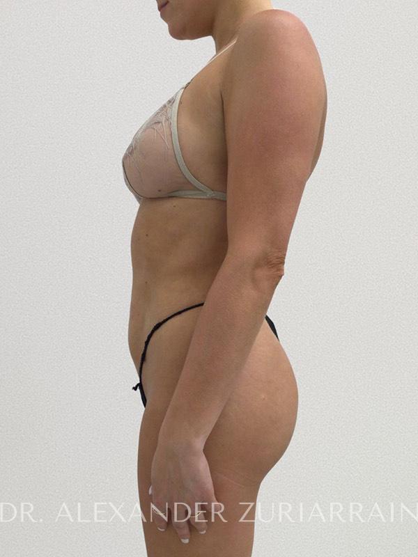 Liposuction before & after photo
