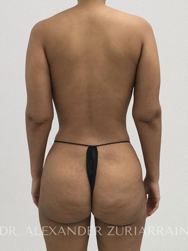 Liposuction before & after photo