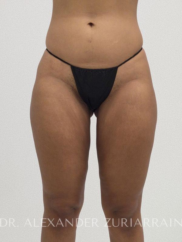 Liposuction before & after photo