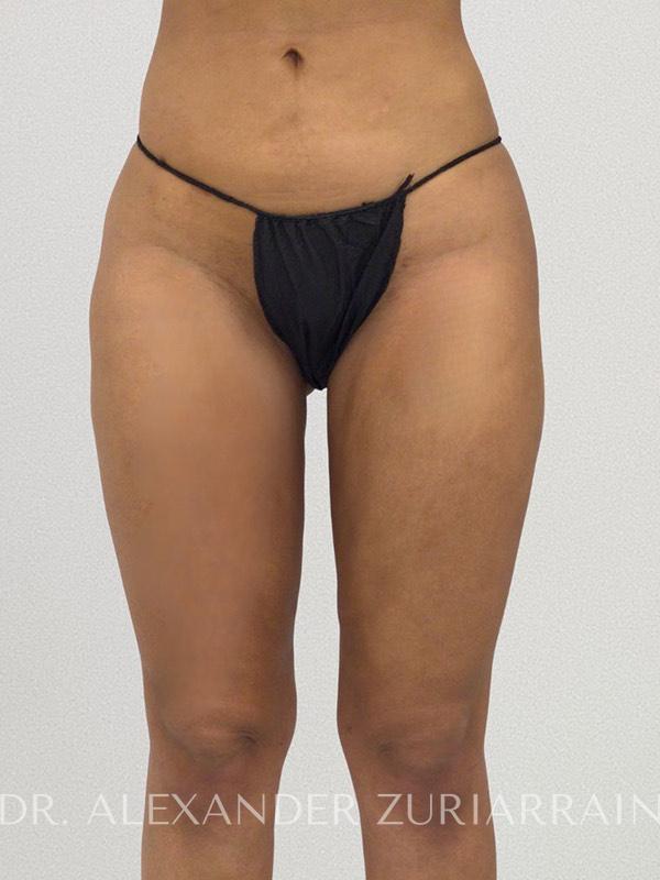Liposuction before & after photo