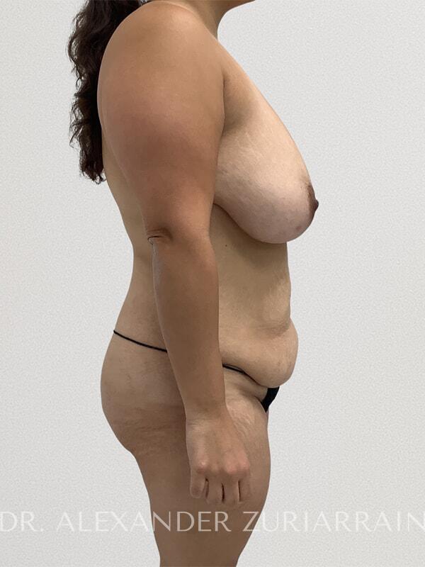 Liposuction before & after photo