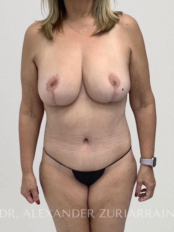 Lower body lift before & after photo