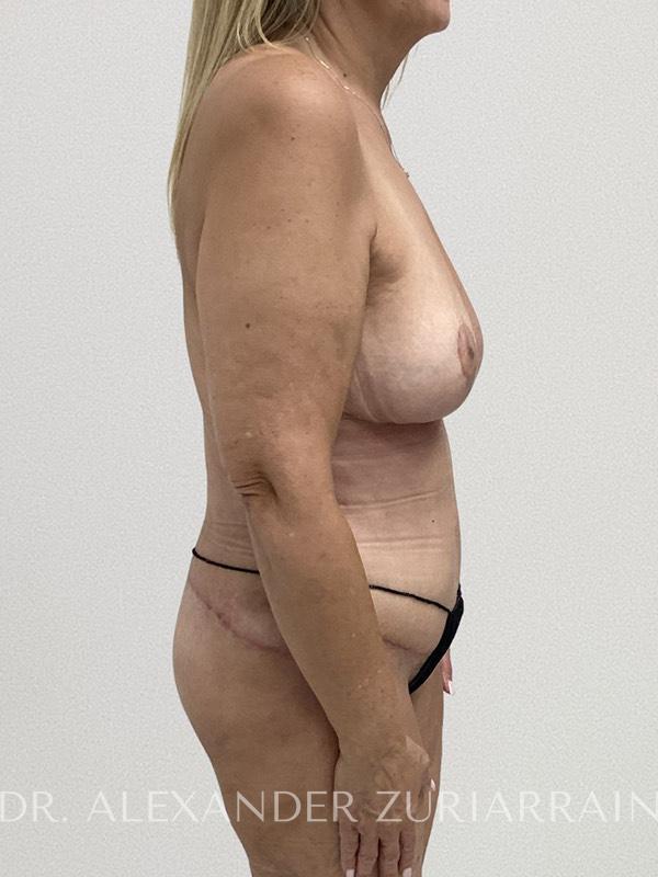 Lower body lift before & after photo