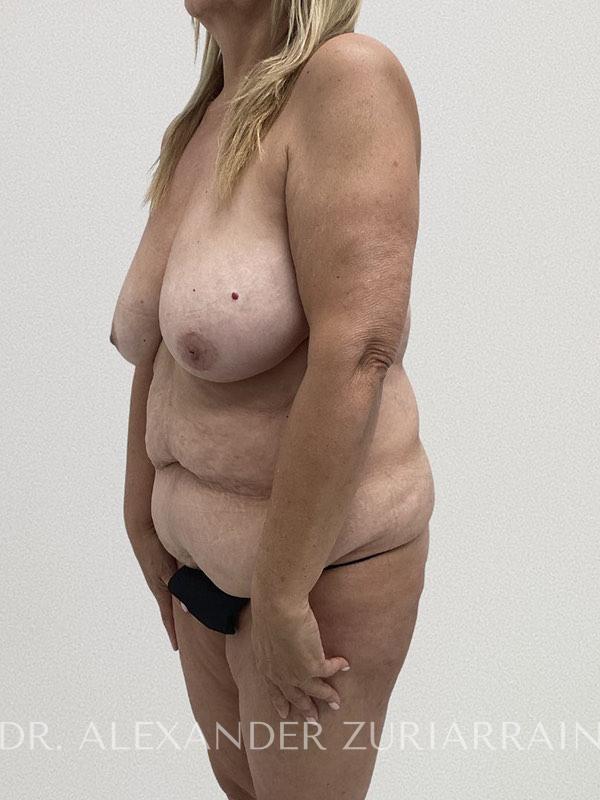 Lower body lift before & after photo