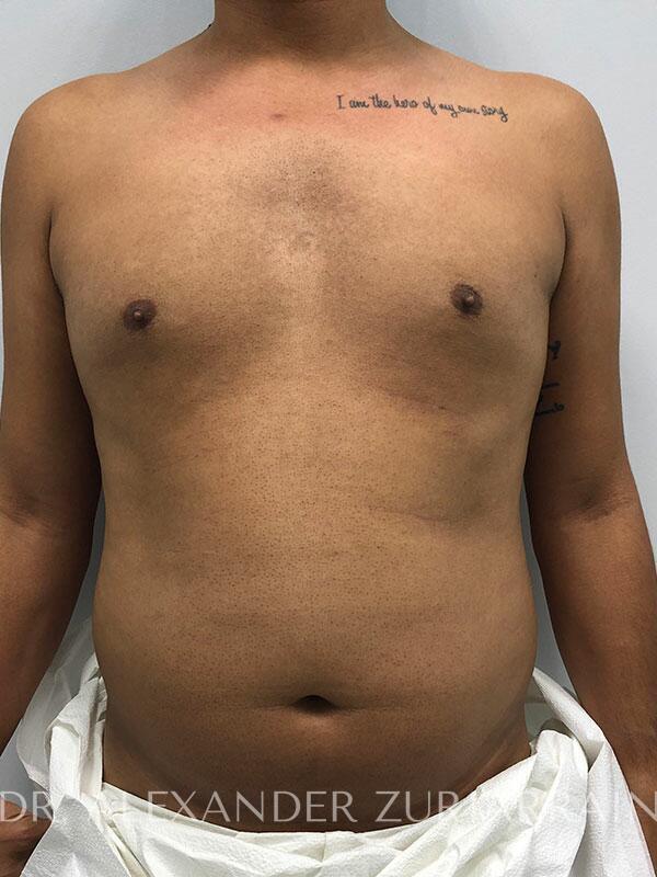 Liposuction Before & After Gallery