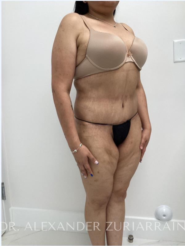 Massive weight loss before & after photo