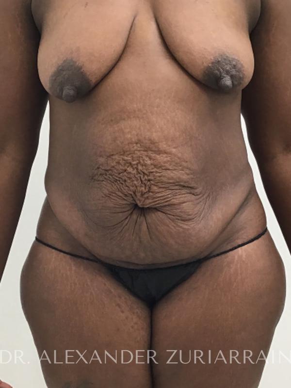 Massive weight loss before & after photo