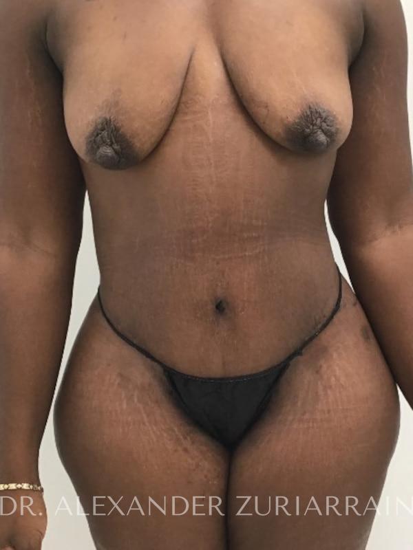 Massive weight loss before & after photo