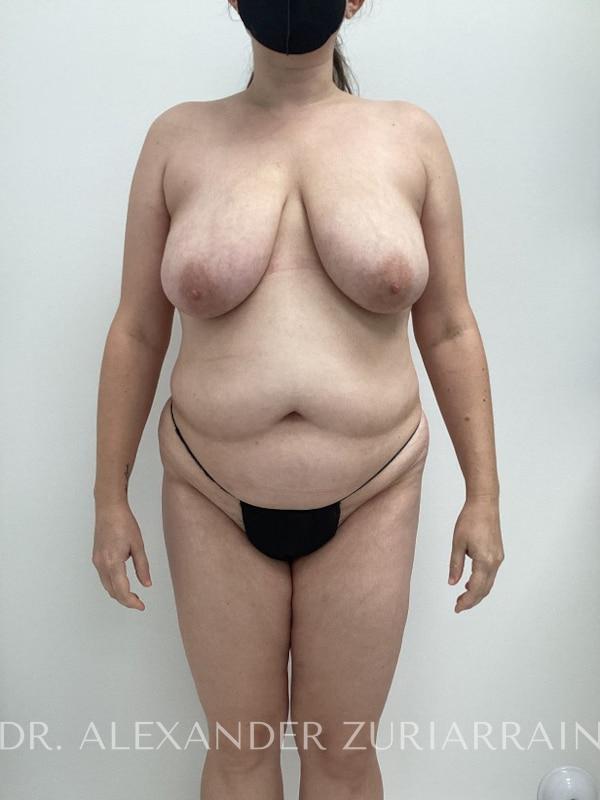 Massive weight loss before & after photo