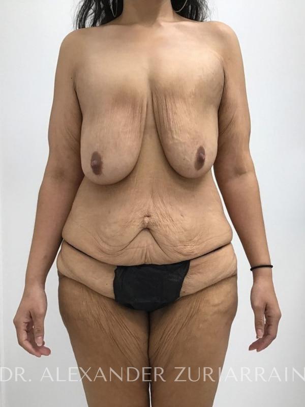 Massive weight loss before & after photo