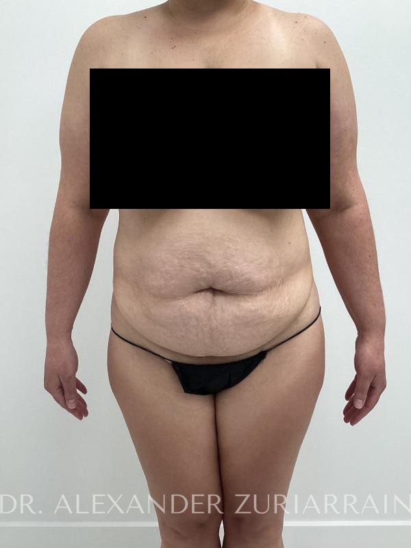 Massive weight loss before & after photo