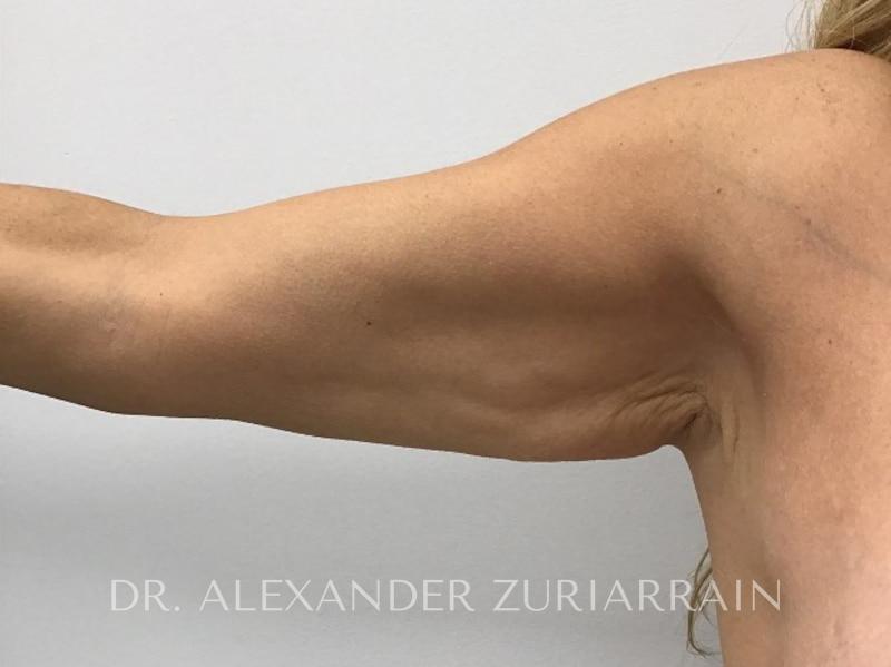 Massive weight loss before & after photo