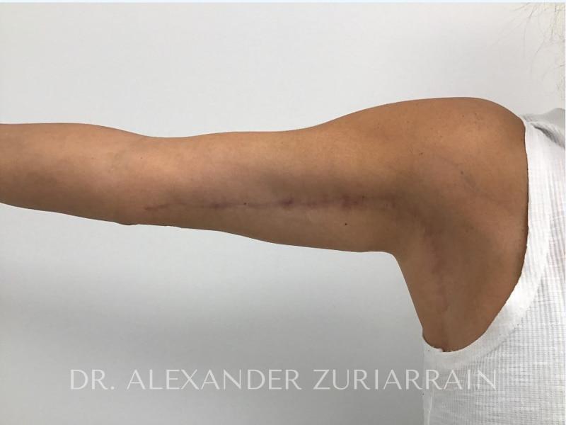 Massive weight loss before & after photo