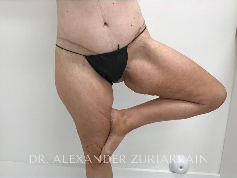 Massive weight loss before & after photo