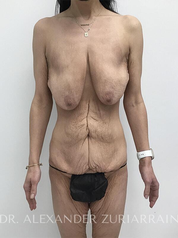 Massive weight loss before & after photo