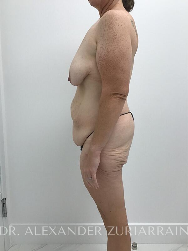 Massive weight loss before & after photo
