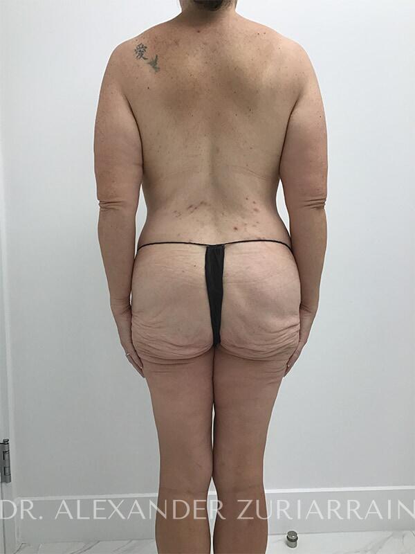 Massive weight loss before & after photo