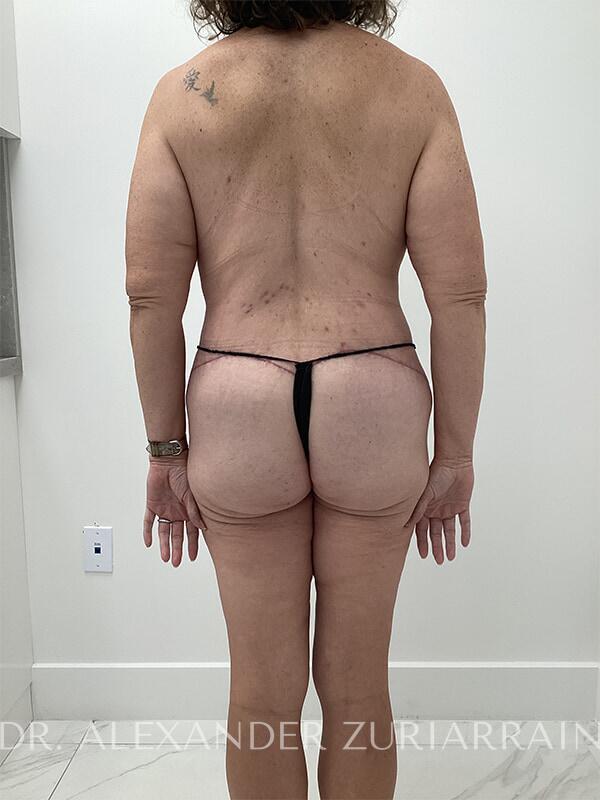 Massive weight loss before & after photo
