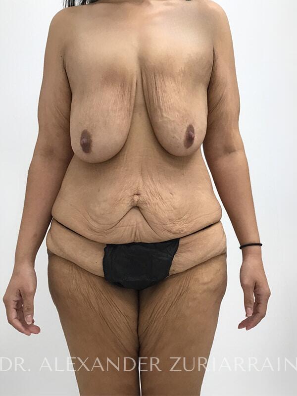 Massive weight loss before & after photo