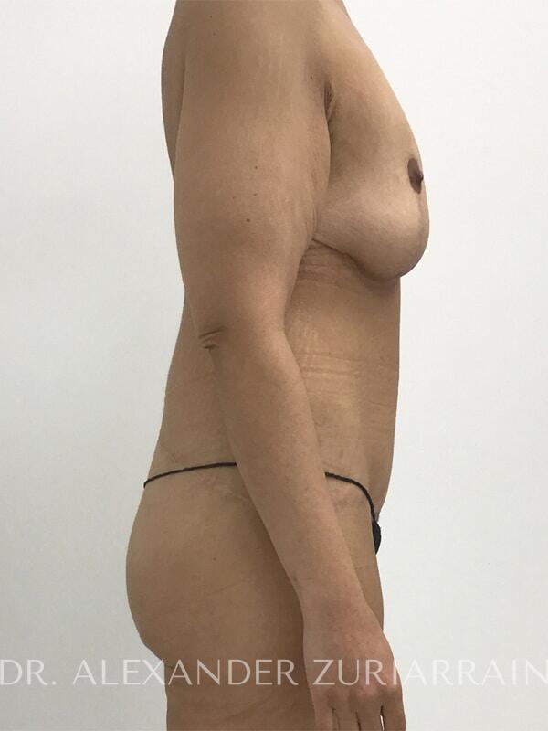 Massive weight loss before & after photo