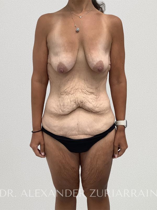 Massive weight loss before & after photo