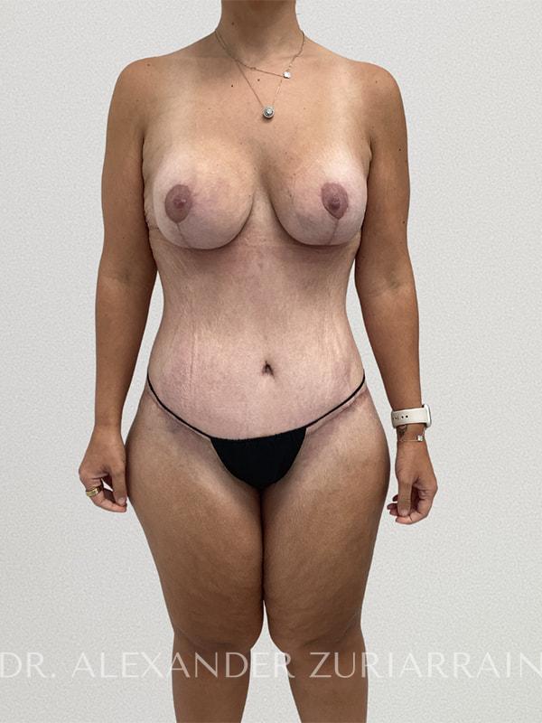 Massive weight loss before & after photo