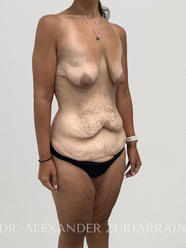 Massive weight loss before & after photo