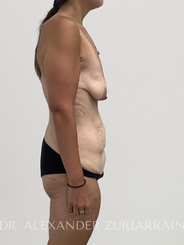 Massive weight loss before & after photo