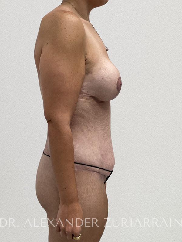 Massive weight loss before & after photo