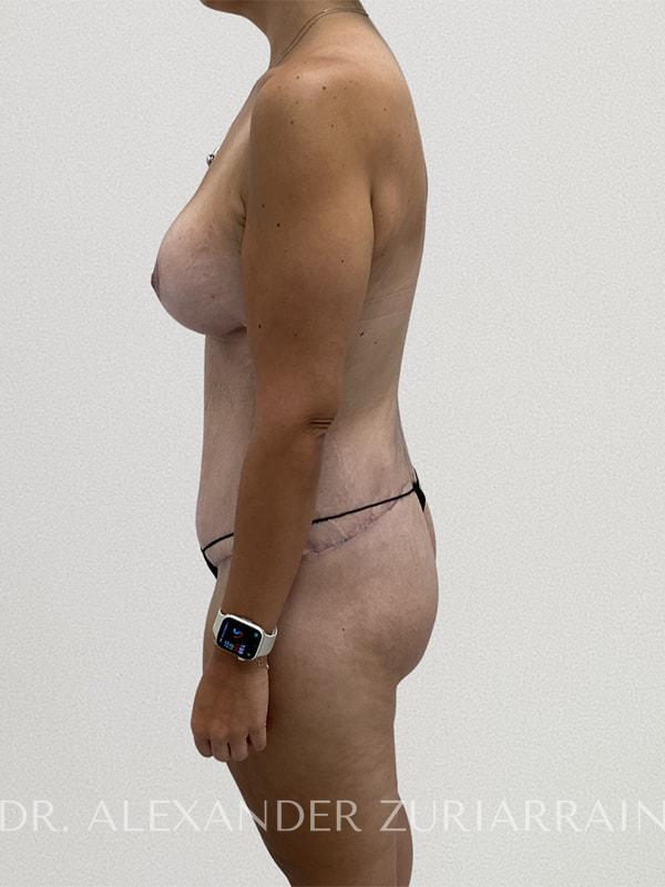 Massive weight loss before & after photo