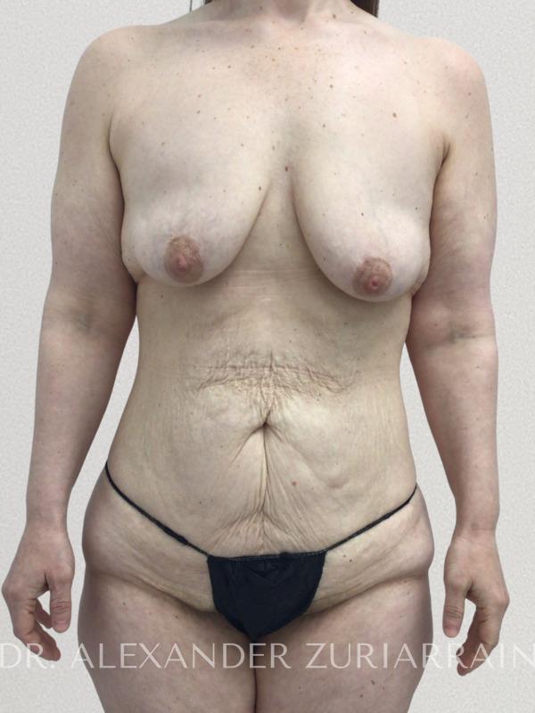 Massive weight loss before & after photo