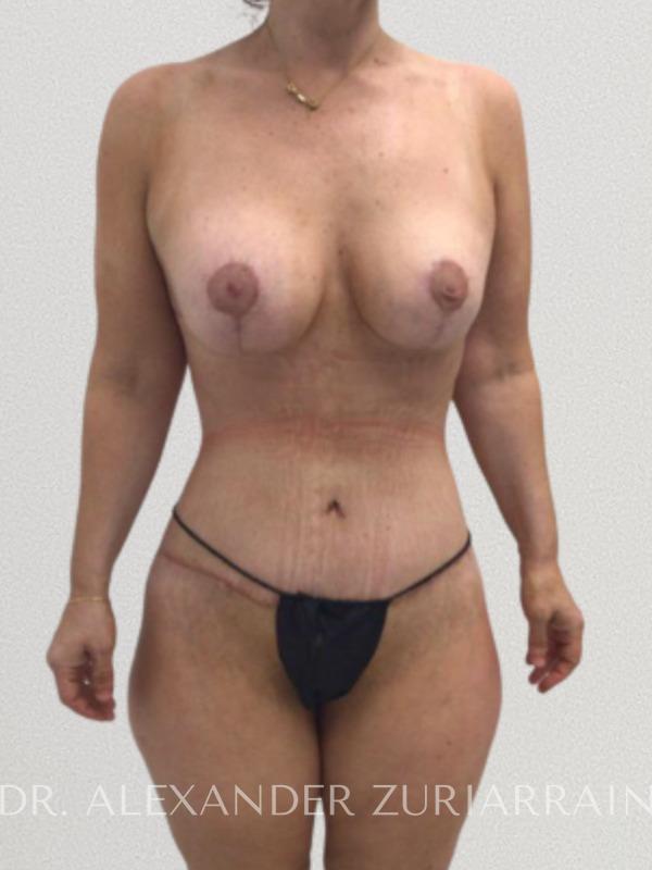 Massive weight loss before & after photo
