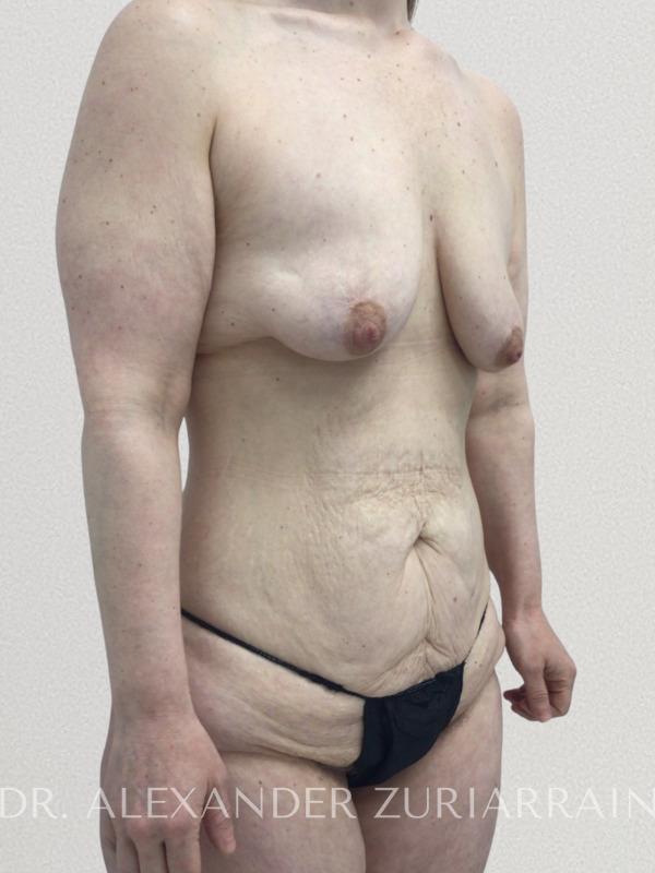Massive weight loss before & after photo