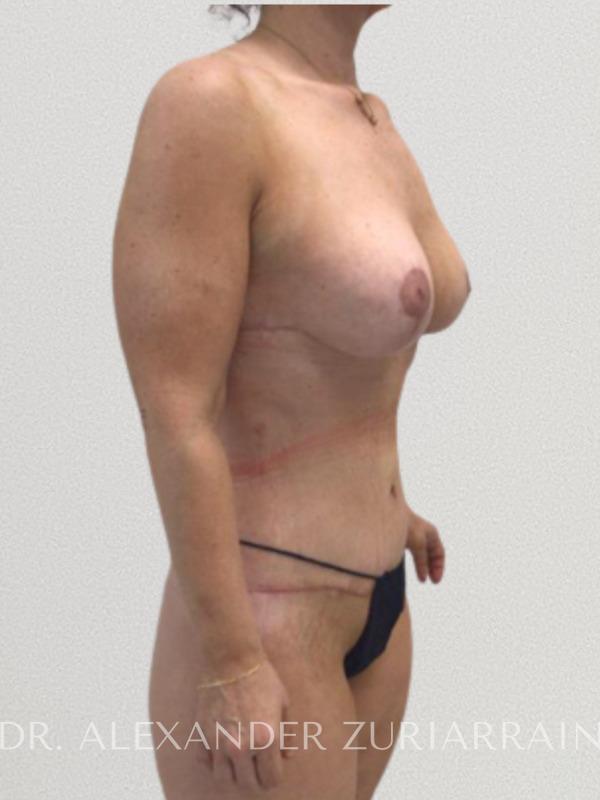 Massive weight loss before & after photo