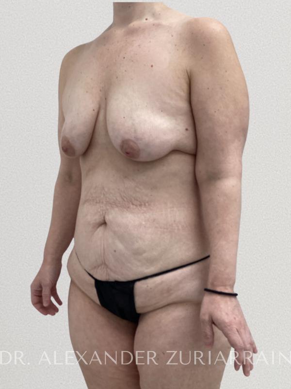 Massive weight loss before & after photo