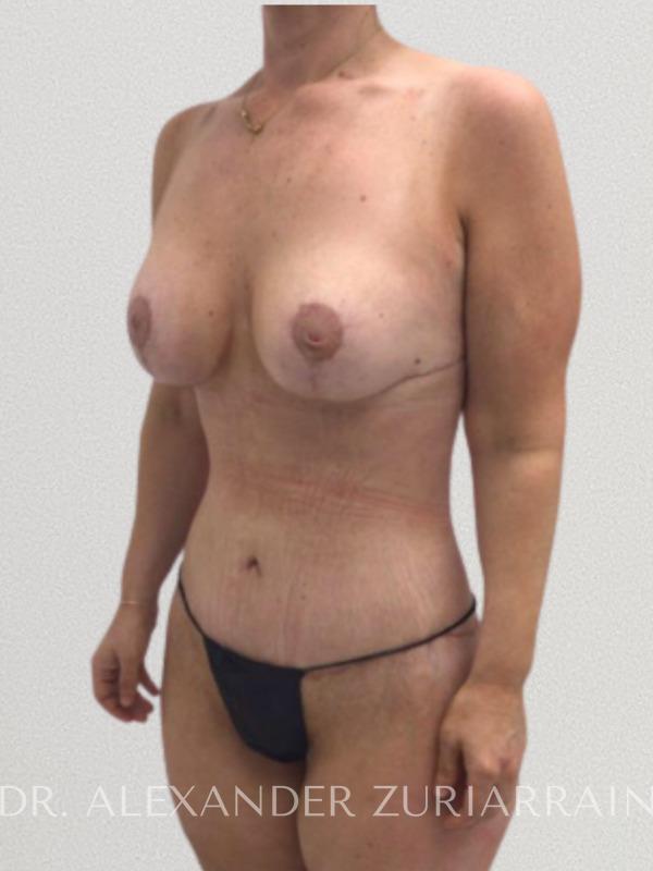 Massive weight loss before & after photo