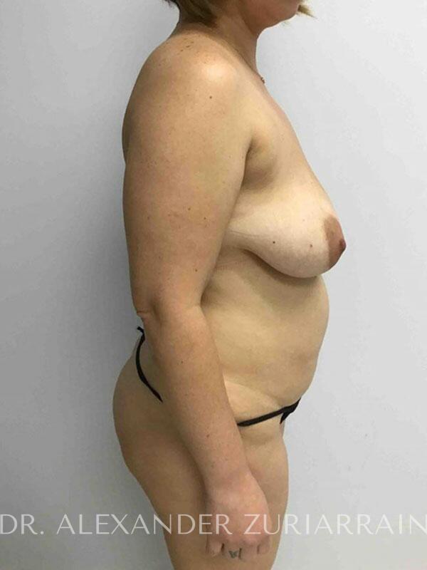 Mommy makeover before & after photo