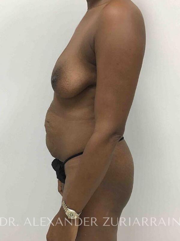 Mommy makeover before & after photo