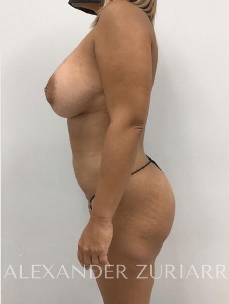 Mommy makeover before & after photo