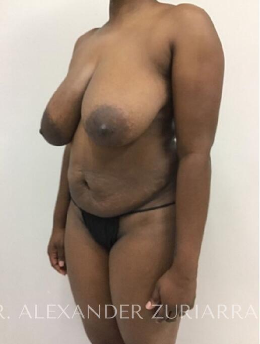 Mommy makeover before & after photo