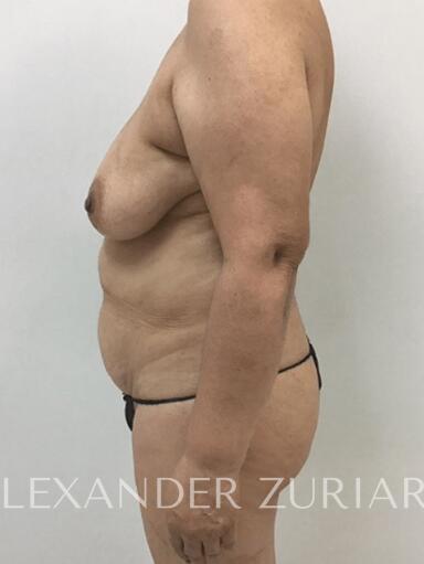 Mommy makeover before & after photo
