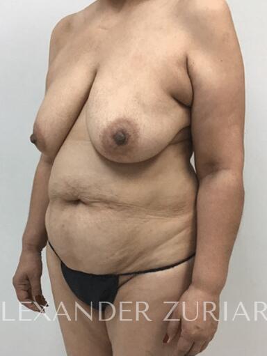 Mommy makeover before & after photo