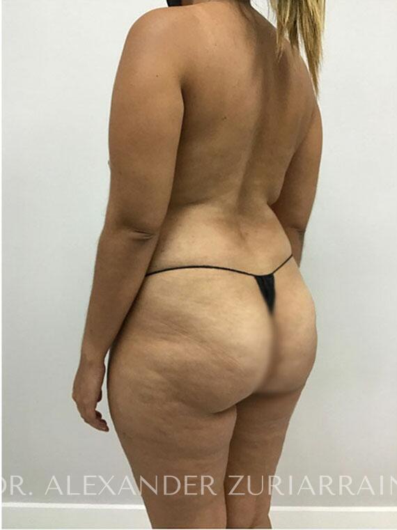 Mommy makeover before & after photo