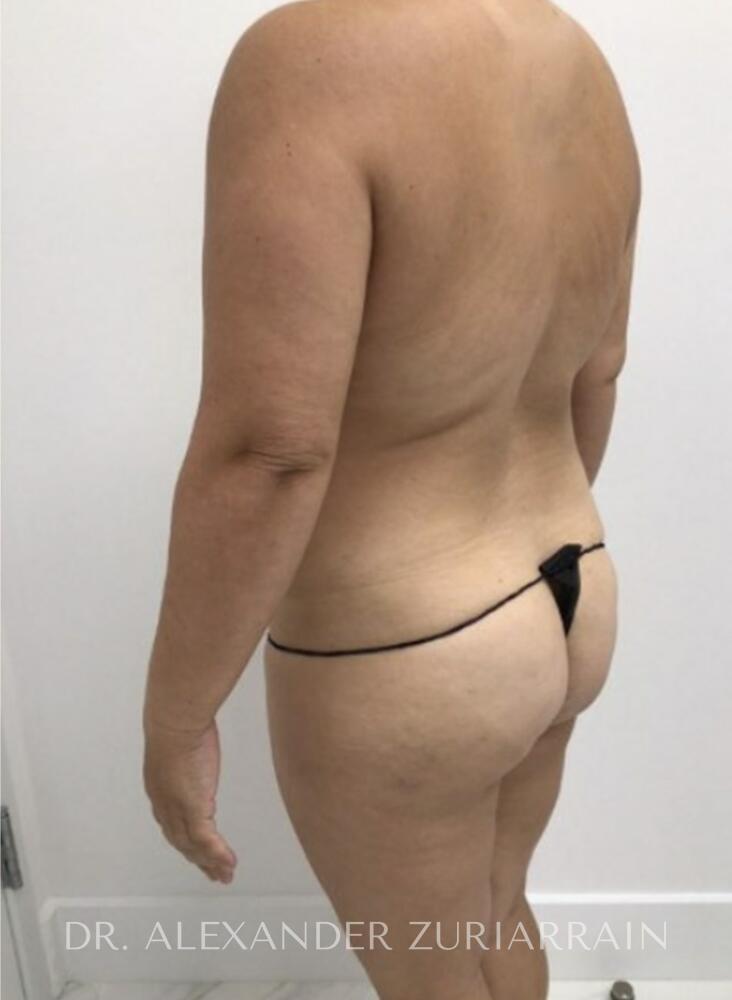 Mommy makeover before & after photo