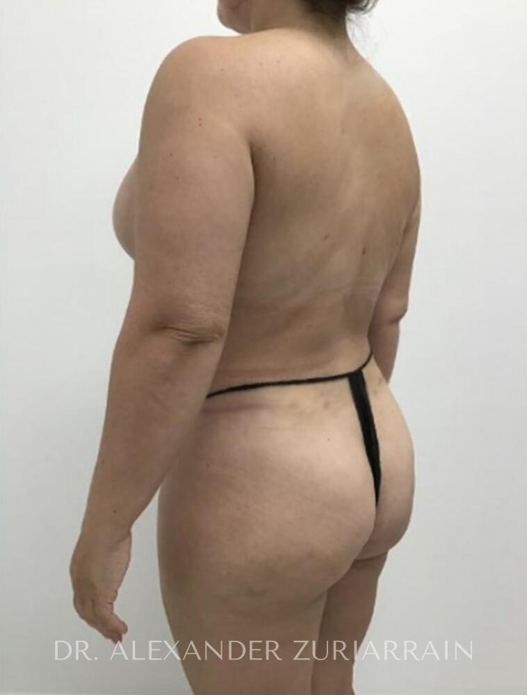 Mommy makeover before & after photo