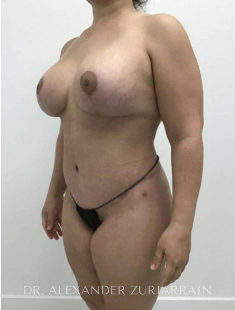 Mommy makeover before & after photo